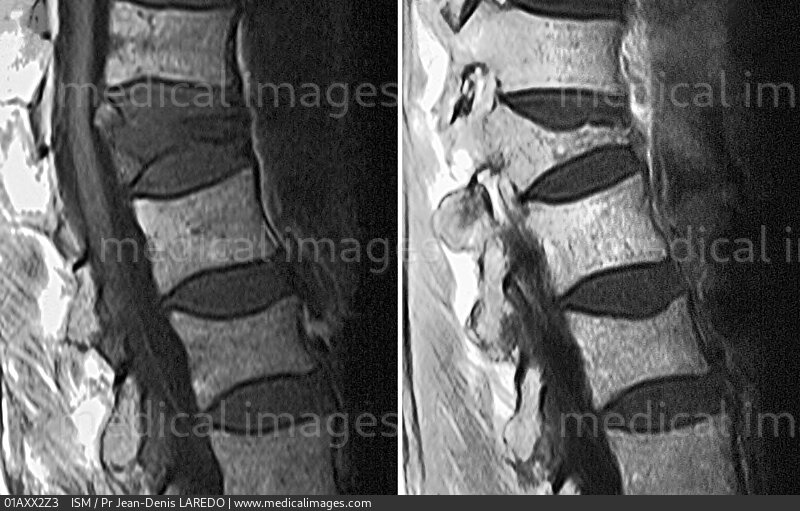 Stock Image Osteoporosis With Compression Fracture Of The T Vertebra